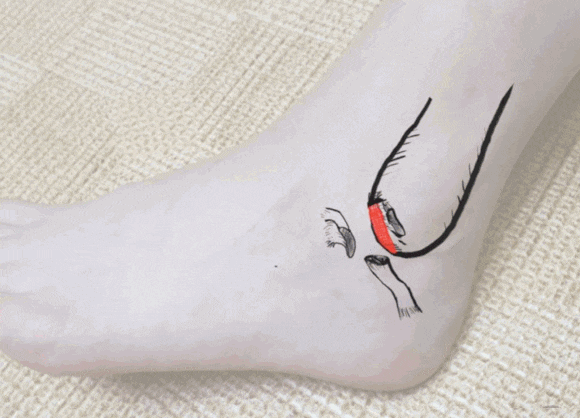 발목 인대 수술 찐 후기